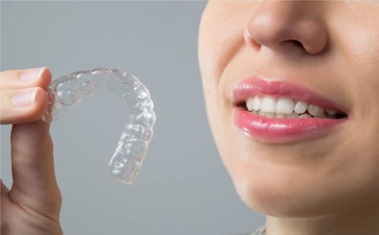 Apparecchio Invisalign per adulti