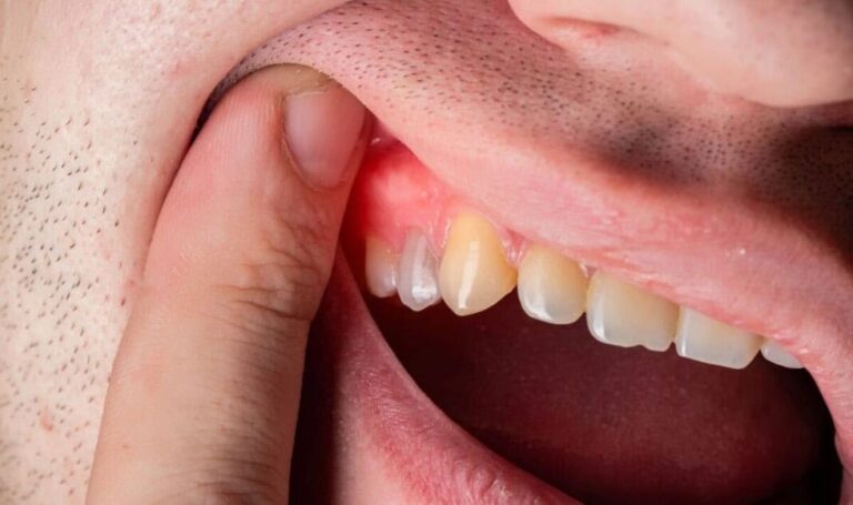 come prevenire la malattia parodontale