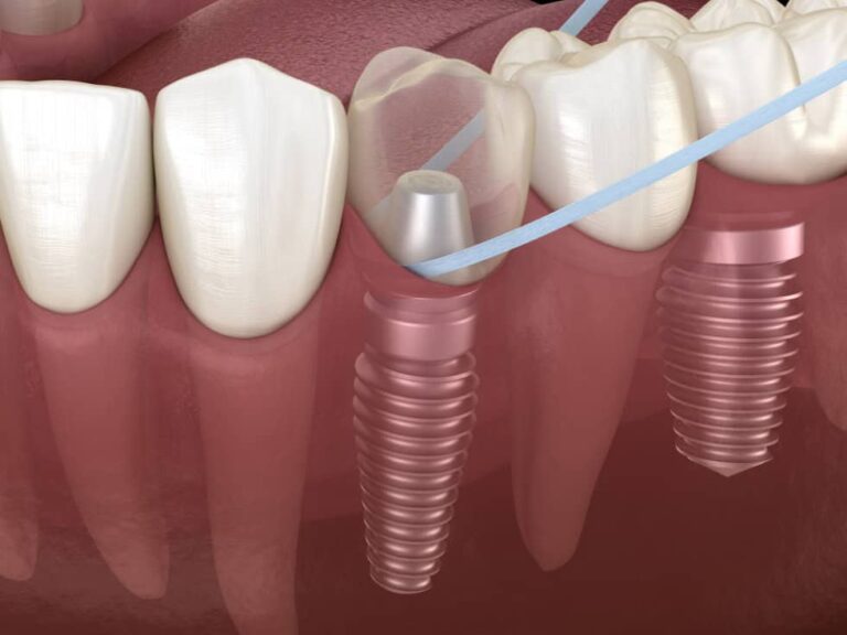 Come prendersi cura degli impianti dentali