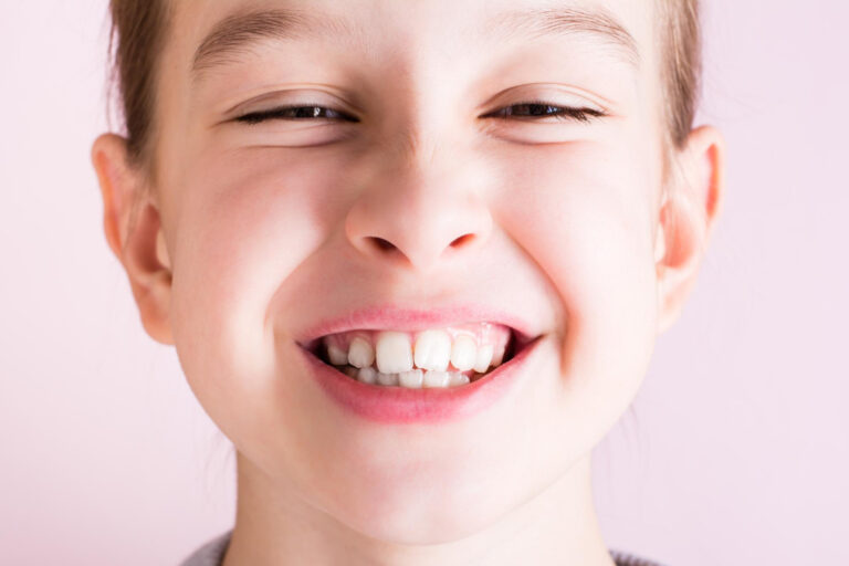 Denti storti o sporgenti nei bambini