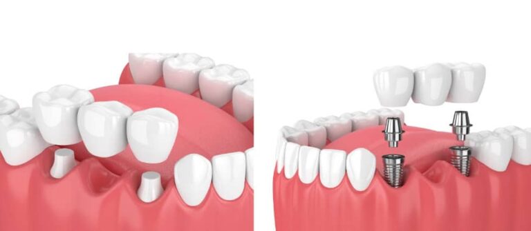 Differenza tra impianto dentale e ponte