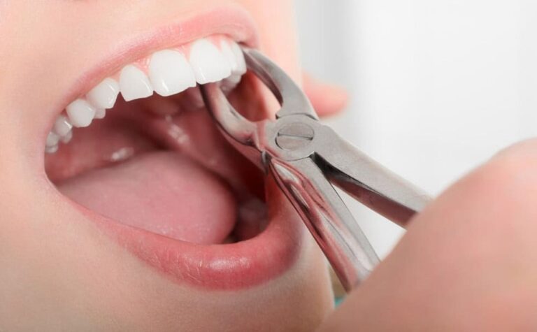 Estrazione dentale