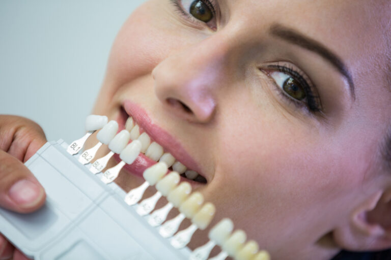 Faccette dentali in ceramica