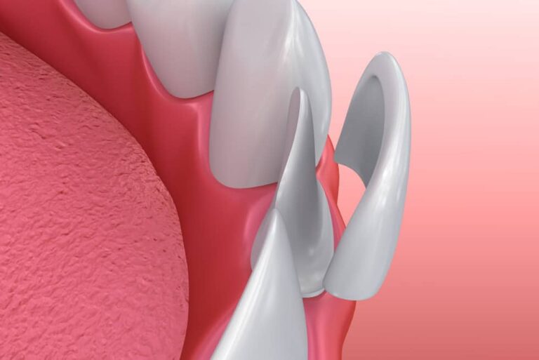 Faccette dentali in ceramica