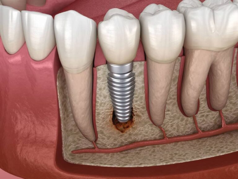 Impianti dentali e parodontite
