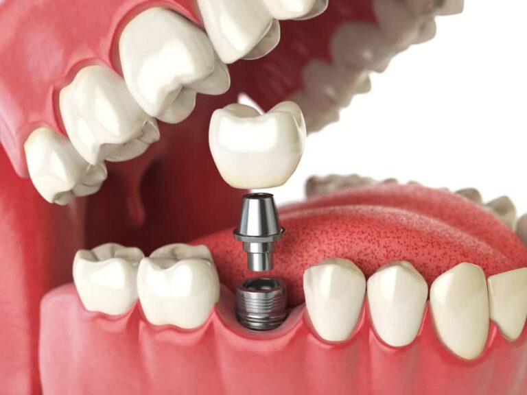 Sostituire i denti mancanti