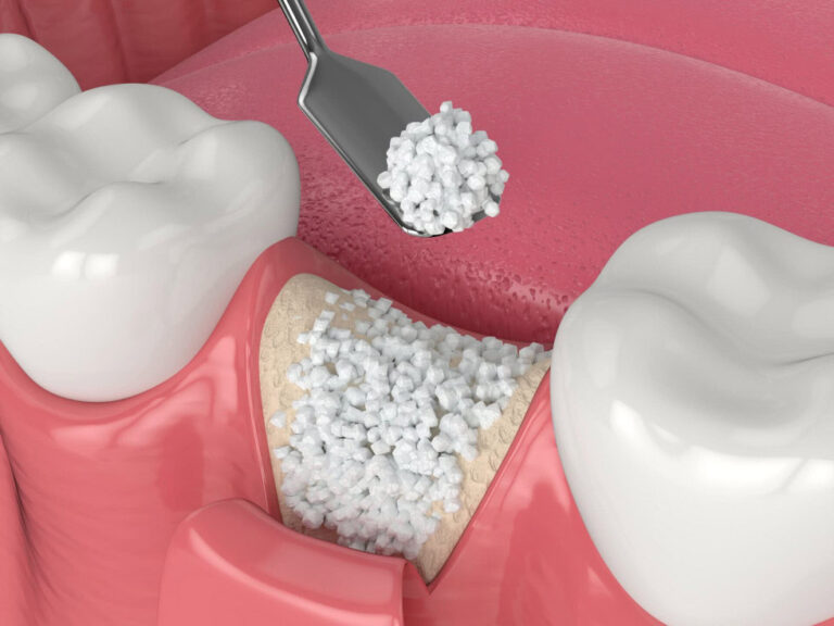 Innesto osseo per impianti dentali