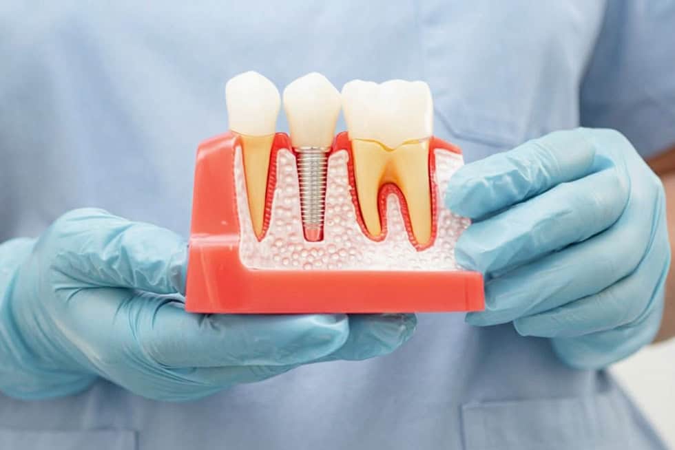 Modello dentale con un impianto in titanio fra due denti naturali