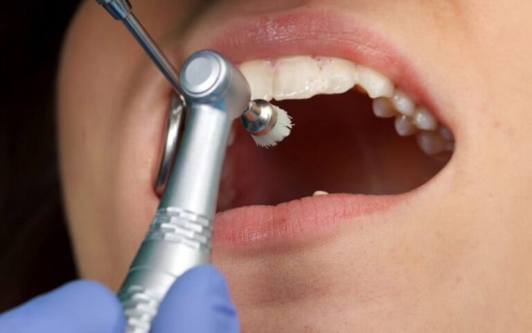 Pulizia dei denti professionale