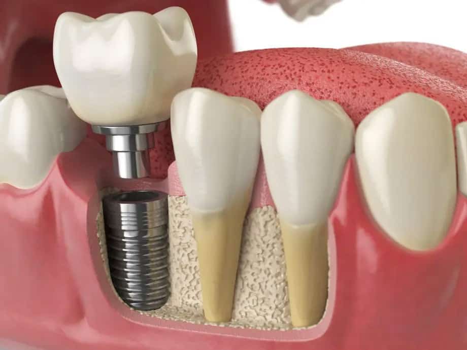 Perché scegliere gli impianti dentali