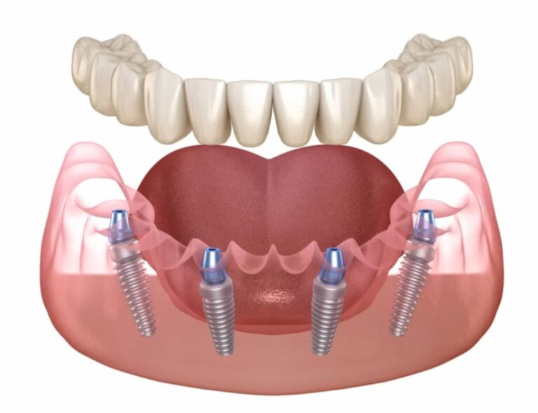 Tipi di impianti dentali