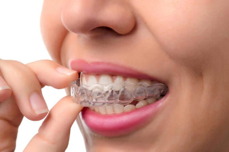 I vantaggi dell’apparecchio Invisalign