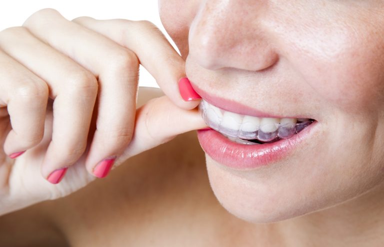 invisalign2-768x495