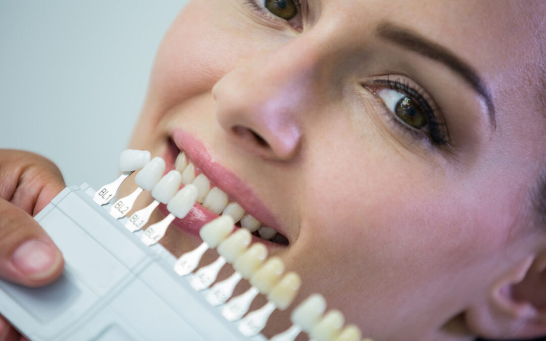 Faccette dentali in ceramica