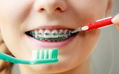 Come lavarsi i denti con l’apparecchio