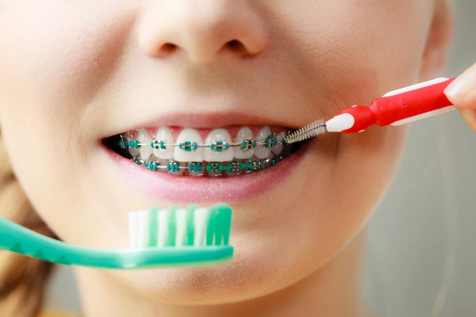 Come lavarsi i denti con l’apparecchio