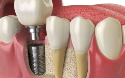 Perché dovresti scegliere gli impianti dentali