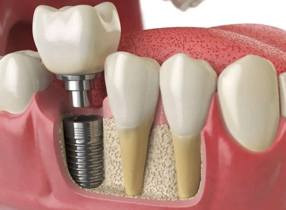 Perché scegliere gli impianti dentali