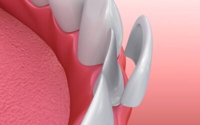 Come si applicano le faccette dentali in ceramica?