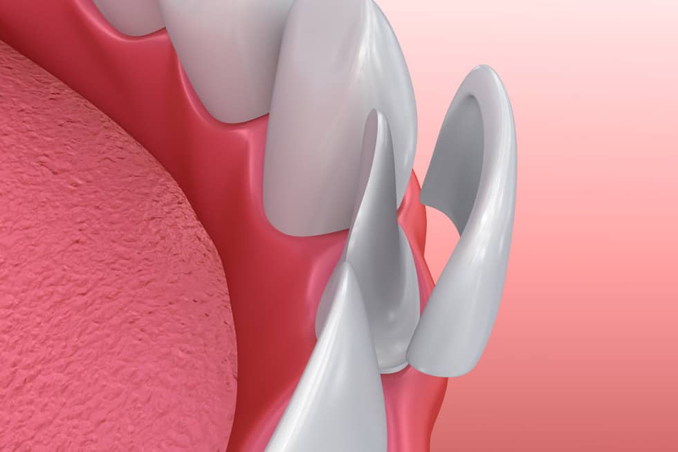 Faccette dentali in ceramica