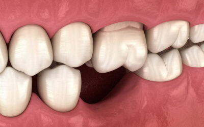 Cosa fare se perdi un dente