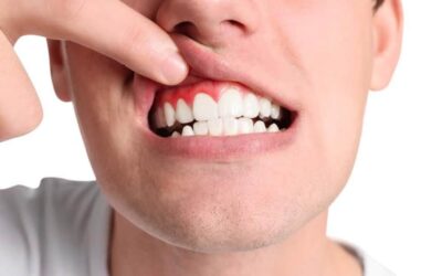 Le cause della recessione delle gengive