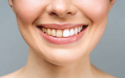 Cause della decolorazione dei denti e come prevenirle