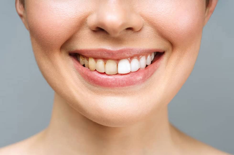 Cause della decolorazione dei denti