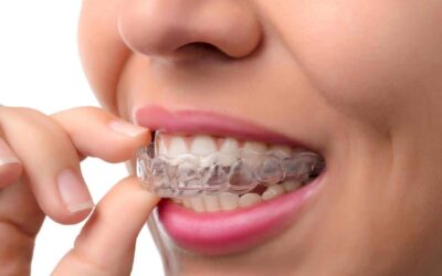 I vantaggi dell’apparecchio Invisalign