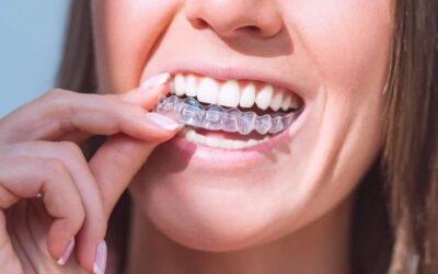 Gli errori da evitare con l’apparecchio Invisalign