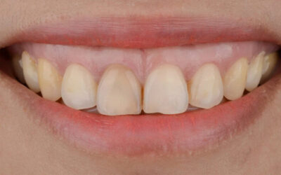 Sorriso gengivale: cosa è e come risolverlo