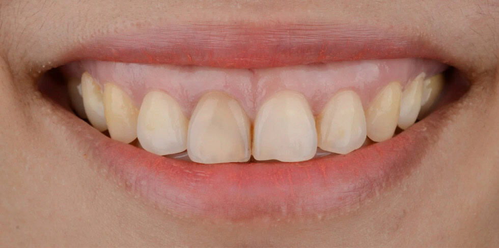 Sorriso gengivale: cosa è e come risolverlo