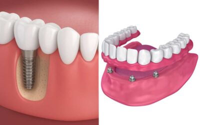 Impianti dentali o dentiere: quale differenza?