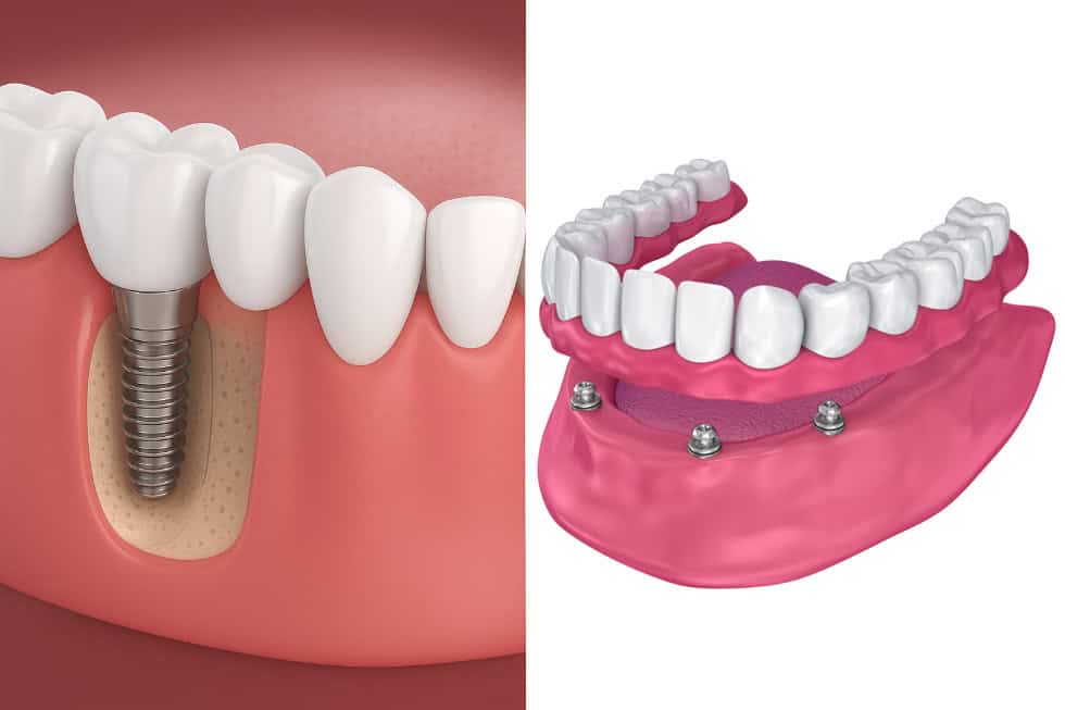 Impianti dentali o dentiere: quale differenza?