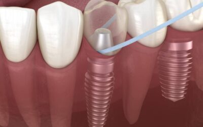 Come prendersi cura degli impianti dentali
