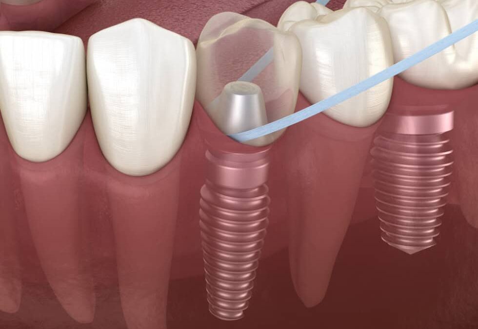 Come prendersi cura degli impianti dentali