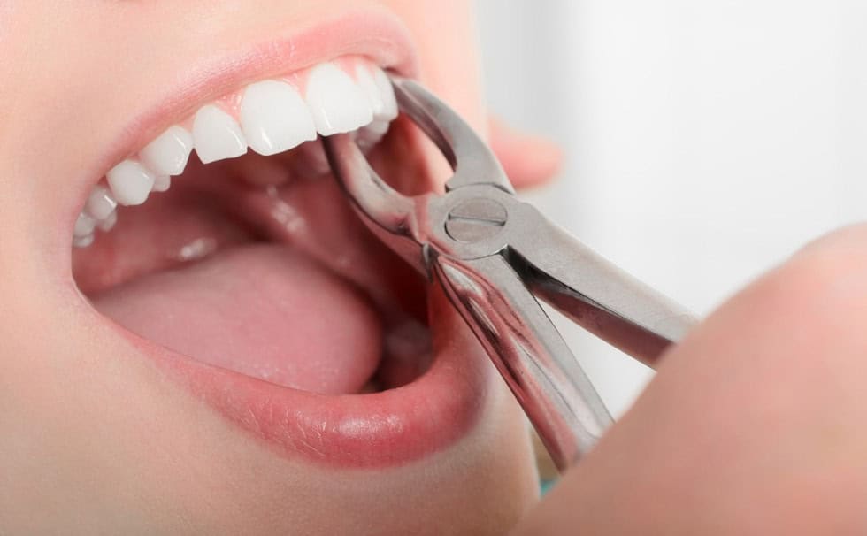 Quando è necessaria un’estrazione dentale