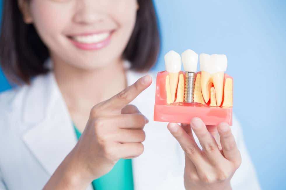 Comprendere i vantaggi degli impianti dentali