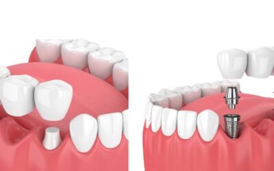 Impianto dentale e ponte: qual è la differenza e qual è il migliore?