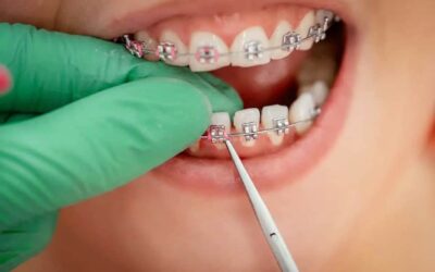 È possibile ottenere lo sbiancamento dei denti con l’apparecchio ortodontico?